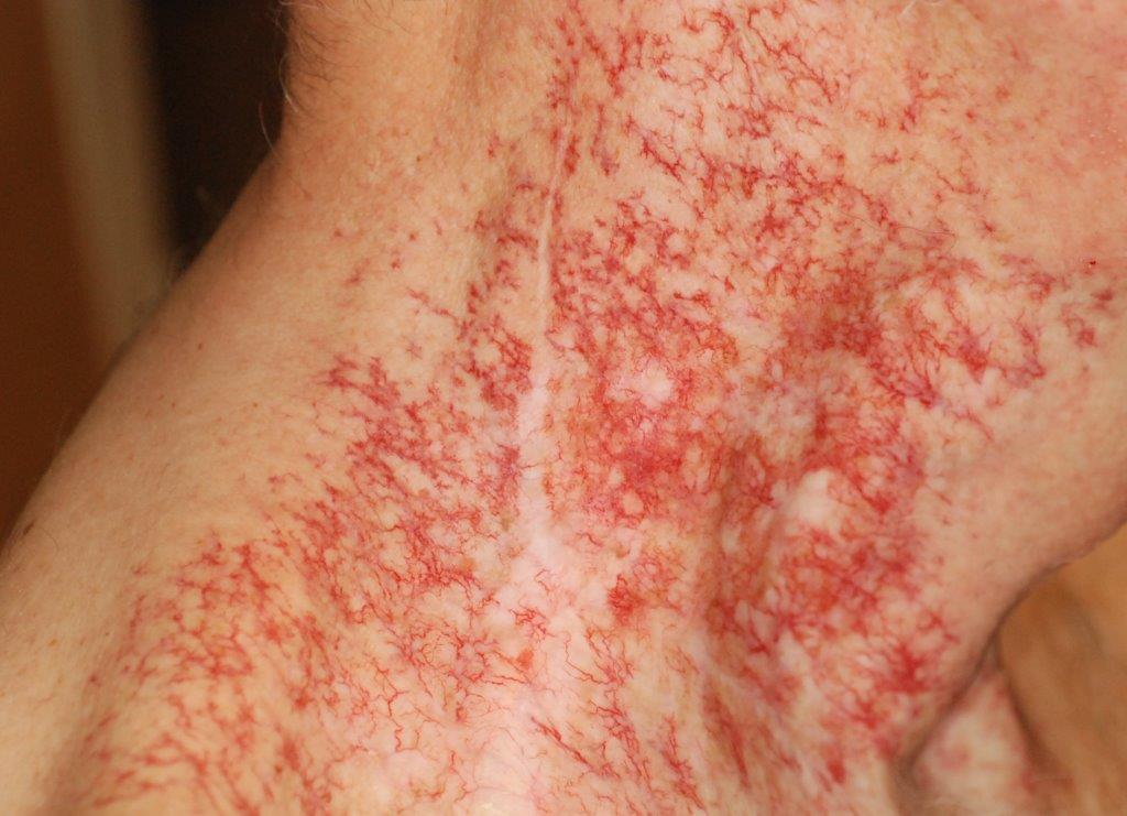 Rally | Treatment to Improve the Hardening (or Fibrosis) of Skin ...