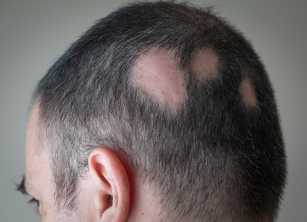 Bestrahlung haarausfall